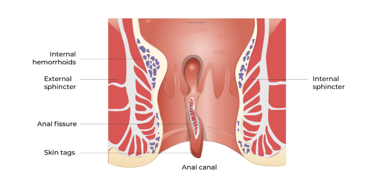 Best Fissure Treatment in Kamothe