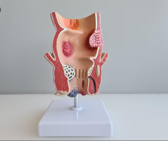 Best Piles Treatment in Kamothe